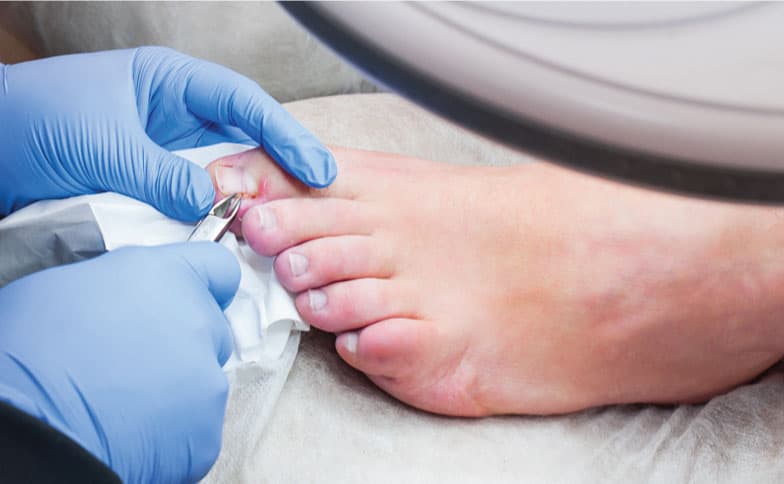Wedge excision of ingrowing nail