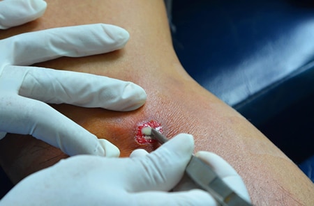Incision and drainage (abscess / sebaceous cyst)